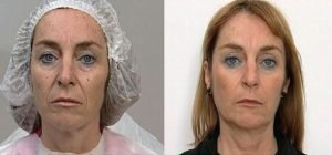 Curso Práctico de Implantología y Rellenos Faciales e-Learning 1