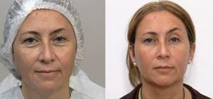 Curso Práctico de Implantología y Rellenos Faciales e-Learning 2